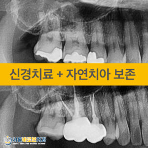 금광동신경치료-서울바로본치과-증례-앞표지