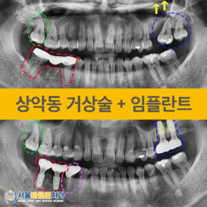 금광동임플란트-서울바로본치과-증례-앞표지