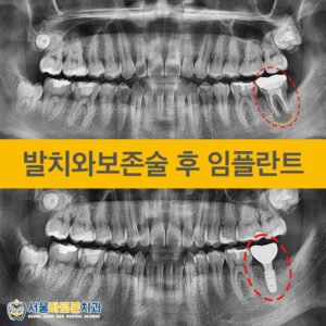금광동치과-서울바로본치과-증례-앞표지