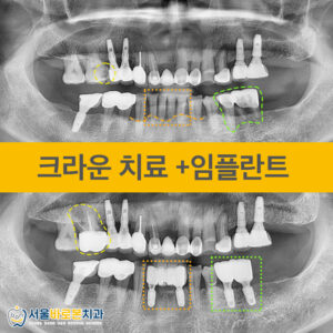 금광동치과-서울바로본치과-증례-앞표지