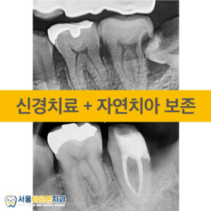금광동치과-서울바로본치과-증례-앞표지