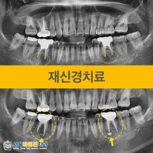 성남치과-서울바로본치과-증례-앞표지