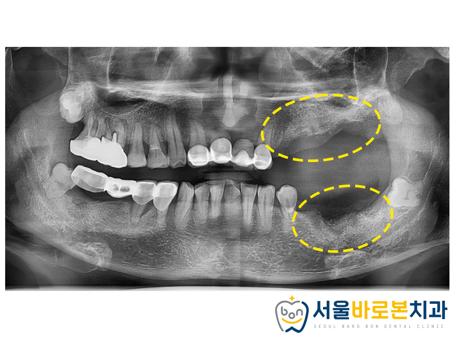 금광동임플란트