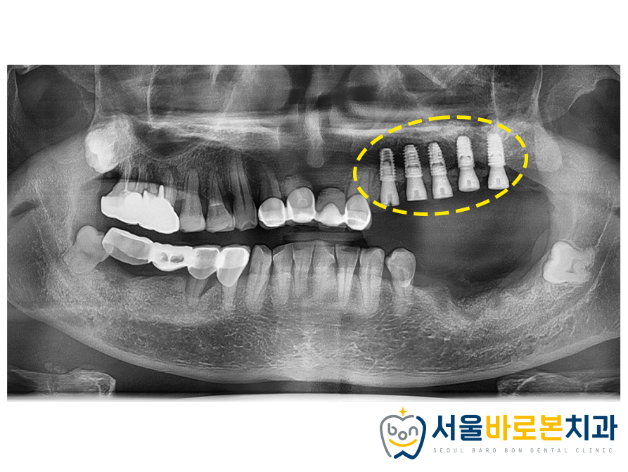 금광동임플란트