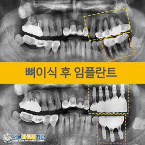 금광동임플란트