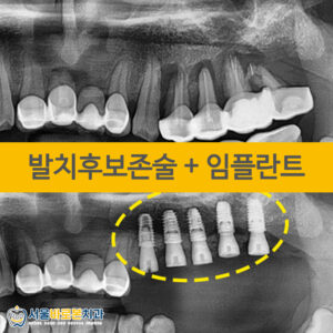 금광동임플란트