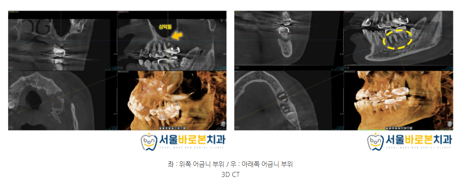 금광동임플란트