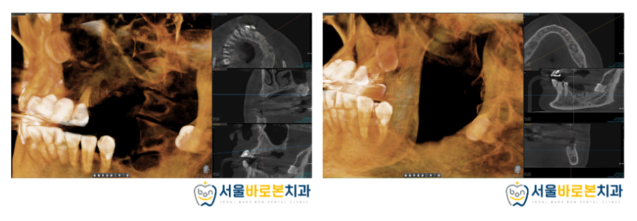 금광동임플란트