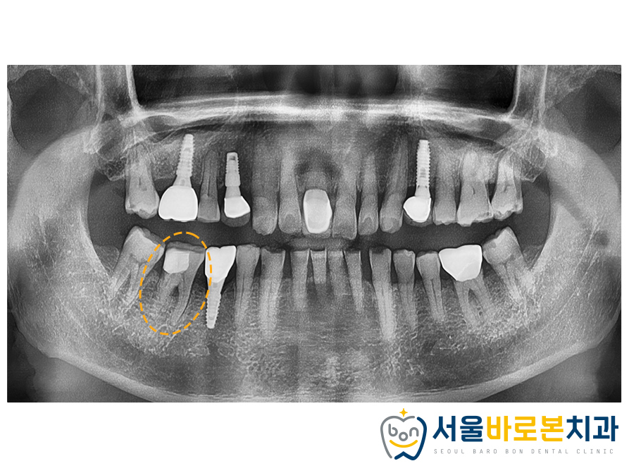 금광동임플란트