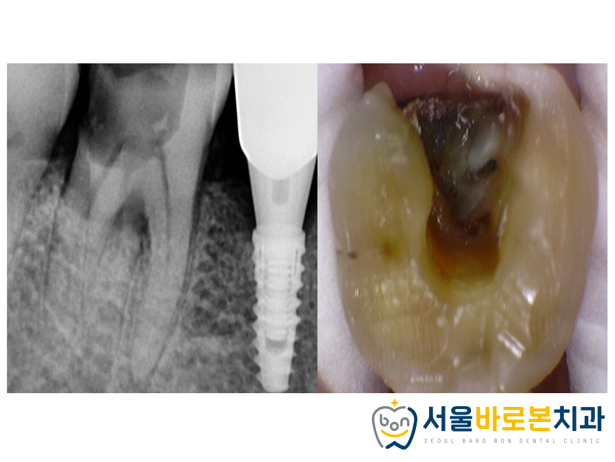 금광동임플란트