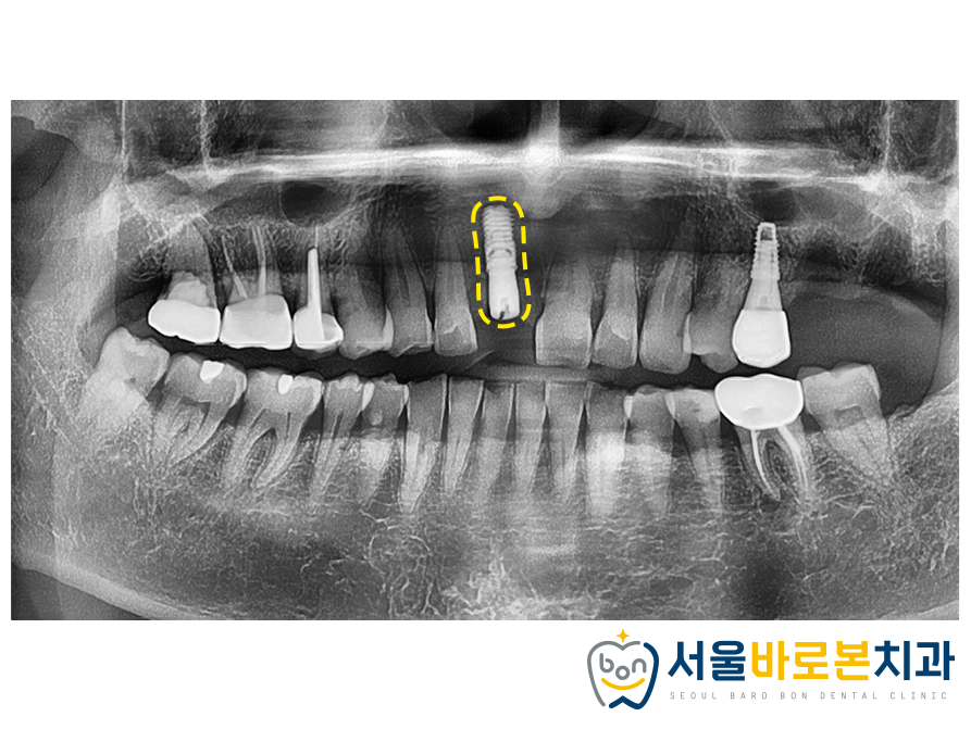 금광동임플란트
