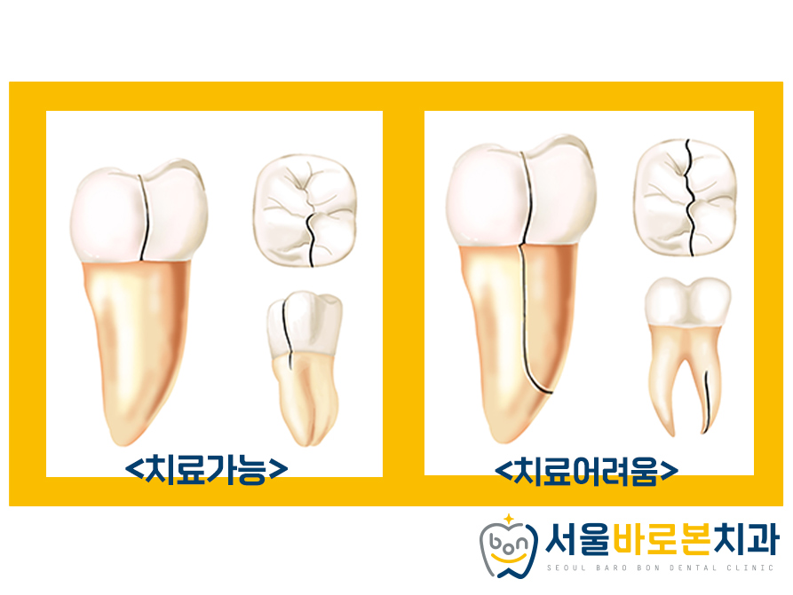 금광동임플란트