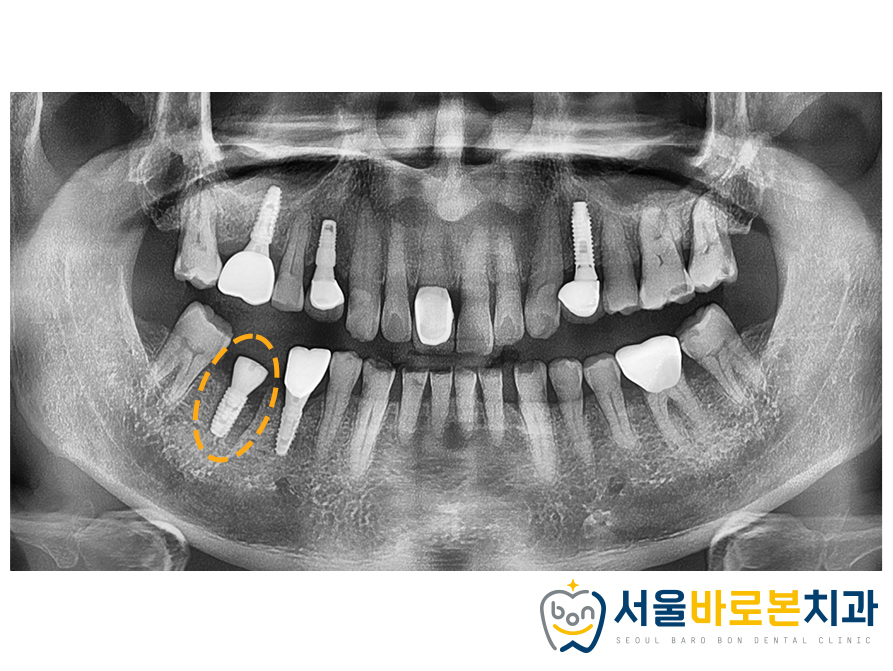 금광동임플란트