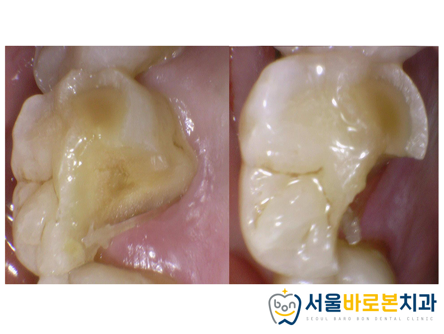 금광동임플란트