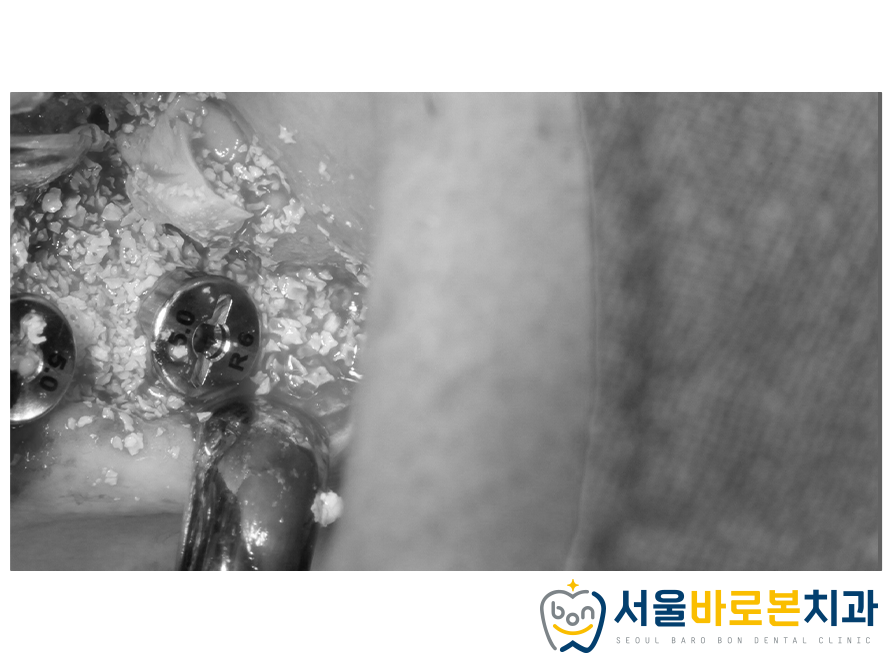 금광동임플란트