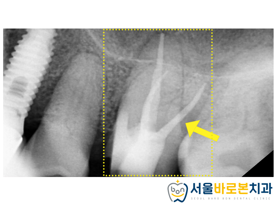 금광동임플란트