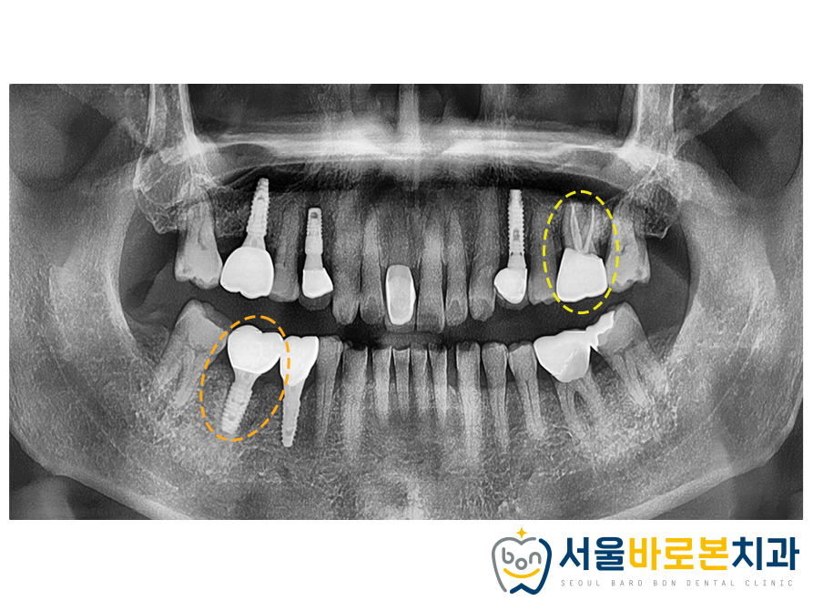 금광동임플란트