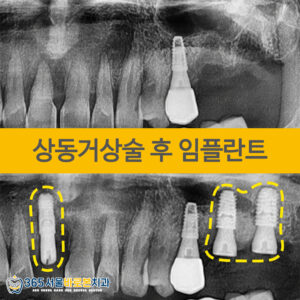금광동임플란트