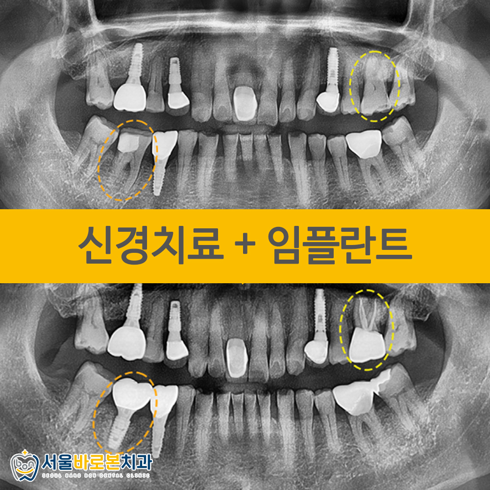 금광동임플란트