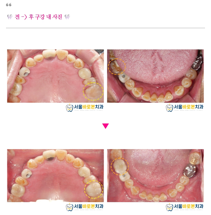 금광동임플란트