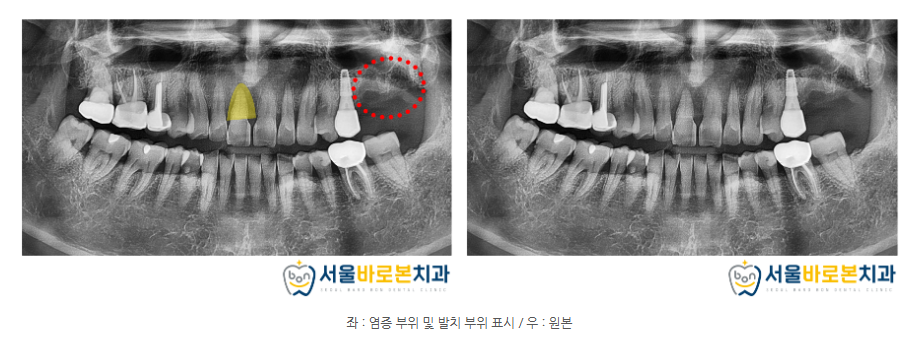 금광동임플란트