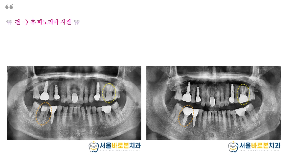 금광동임플란트
