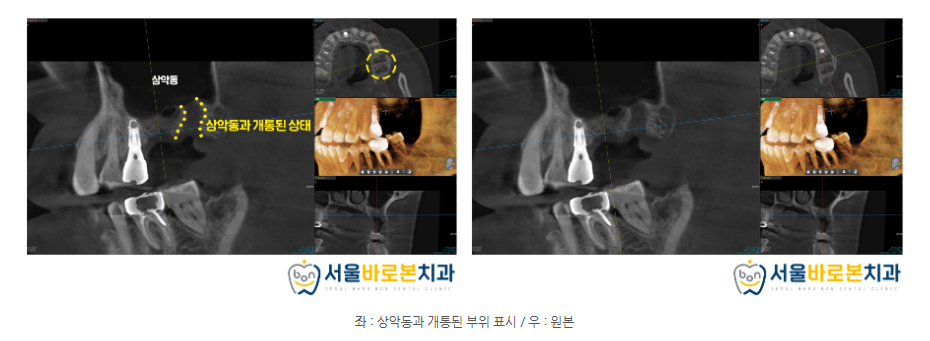 금광동임플란트