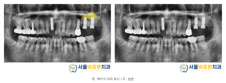 금광동임플란트